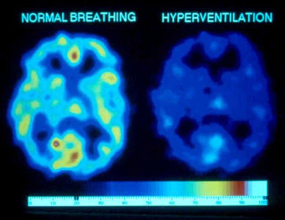 Over breathing and CO2 loss reduces brain oxygenation